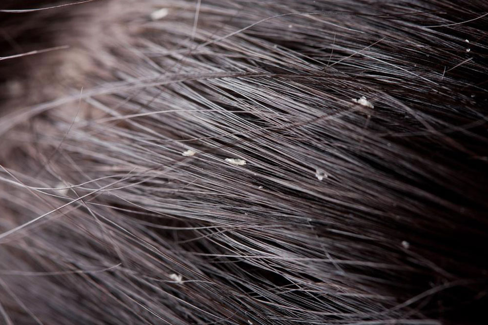 Home Remedies for Dandruff Treatment